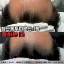 밀스칼프 이미지