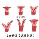 유산이 반복되는 습관성 유산 이미지