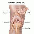 반월판 손상 재활 프로그램 이미지