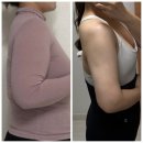 일반 람스 vs 팔뚝 무한람스 가격 차이와 체형별 추천(숫자병원 솔직후기)