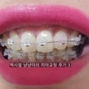 [연세참예쁜치과] 동탄치과상담 앞니 부분교정 동탄교정후기 3 (앞니 틀어짐, 과개교합)
