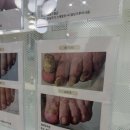 레푸스 앤 쓰담네일 | 대전 문제성 발톱 케어 후기🔥 레푸스앤네일맘 솔직후기 (충격 Before/After)