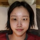 고고 | 구미 형곡 문스 뷰티 여드름관리 솔직 후기‼️