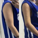 멍머리 | 대구 팔뚝 지방흡입 당일부터 2주차 찐 후기 [멍, 붓기, 통증]