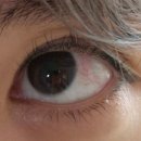 천안서울안과신부점의원 | 발품 팔아 천안 신부동 안과에서 결막 모반 제거했어요