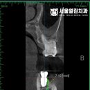 차근차근 진행한 임플란트, 삼송역 치과 완성도 높은 결과의 비결