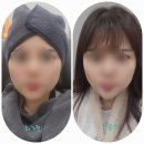 인천 영종도피부과 온다리프팅(ONDA) 솔직후기