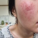 한불스킨케어 | 피부염 단계별 스킨케어 방법 세안방법/최근 스킨케어 기초제품/피부염 크림