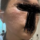 “홍대 톤즈의원 톤즈클리닉”에서 리쥬란힐러 받아본 후기 ! 첫방문이벤트 / 리쥬란힐러 정품인증...