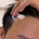 헤어닥터 | 탈모 정수리고민 헤어에센스 추천 닥터토비아 모낭활성제 2주간 솔직 후기