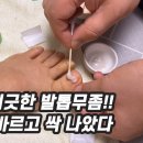 발톰무좀 민간요법치료 이거 바르고 싹 없애세요! 큰 돈 들이지않고 발톱무좀 낫는 법 이미지