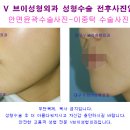 대구안면윤곽사진-주걱턱수술 잘하는 대구성형외과 주걱턱교정술[대구보톡스] 이미지