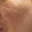 경남한의원 | 부산 서면역 흉터치료 한의원에서 여드름 흉터 새살침 받은 후기