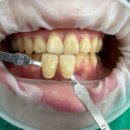 호성한마음치과의원 | 전주 해성치과 치아 미백 / 본원 환자분 실제 후기 / 미백 전,후 사진 (무보정)