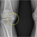 무릎 통증 원인 무릎이 아파요 증세 이유 이미지