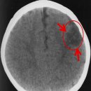 S0140 | 뇌경색(Cerebral Infarction)의 원인부터 치료까지: 영상소견과 함께 보는 포괄적 해설