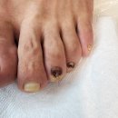 포쉬네일 풀리메디 안산점 | 안산발톱무좀 내성발톱, 조하혈종까지 포쉬네일 동성제약 풀리메디 안산점에서 해결하는 중