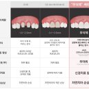 WE치과기공소 | 무삭제 쎄라필름을 고민하는 분이 꼭 보셔야되는 글 by.2D치과(투디치과)