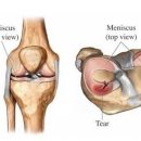 무릎연골손상 가장 빈번하게 일어나는 반월상연골치료 조기에 이루어져야 이미지