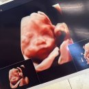 양수1여자 | 난임병원 가기 직전 확인한 임테기 두줄과 노산으로인한 고위험군 양수검사/임당재검, 출산까지