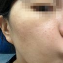 (주)엠포인 | 부산서면피부과 리쥬란보다 효과좋은 스킨부스터 필로드 내돈내산 후기(통증,엠보자국 등)