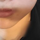 고려수지침 관악 | ✨서울 윤곽주사 이중턱 + 리니어펌 +보톡스 내돈내산 2차 후기(어설픈 전후 사진 있음)