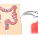 설사,복통,배부글부글은 대장게실 가능성 이미지