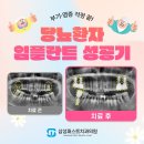 삼성퍼스트치과의원 | [덕양구임플란트] 붓기•염증 걱정 끝! 당뇨 환자 임플란트 성공기 (삼성퍼스트치과_임플란트)