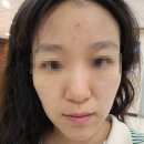 코끝의봄한의원 | 광주새살한의원 얼굴율안약초침 다녀온 후기 (전후사진있음)