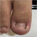 대덕대로168번길 | 대전 월평동 내성발톱 안아프고 확실하게 잘하는 네일의아침 내성발톱 무좀 발각질 네일 문제성발