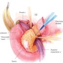 PPPD (pylorus preserving pancreatoduodenectomy) 이미지