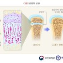 성장판손상골절 진단비 특별약관 이미지