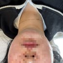 메디포올 | 압구정역 피부관리 메디포올 원쎄라 리프팅 받았어요