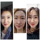 (인셀덤 사용후기)인셀덤 부작용이 너무심해??!