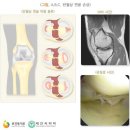 관절경 수술[작은 절개를 통해 관절 내의 치료하는 수술방법] 이미지