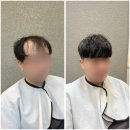 만모헤어 | 탈모로 스타일 못 잡던 30대 남자, 미금 헤어증모술로 해결!