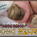 (충격주의) 조갑구만증 치료 이미지