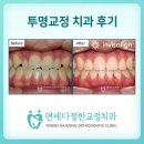 서울미소담은치과의원 | 투명교정 치과 후기로 보는 바쁜 직장인의 교정기간 단축법