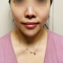 포에버의원 | 청담피부과 포에버의원 헬리오스 레이저토닝 내돈내산 후기