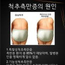 요통, 관절통, 자세이상의 원인 척추측만증 어떻게 개선해야 하나!! 이미지