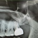 가까운 대학 약국 | 크라운 씌운 치아, 재신경치료 후기 : 동네 치과 &amp; 대학병원 진료투어