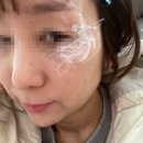 연신내메디칼약국 | &lt;내 돈 내산&gt;기미 잡티제거 레이저 시술 후기, IPL 후기 연신내 불광동 아름다운 성형외과