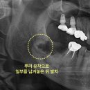 사랑니빠지는구강악안면외과치과의원 | 주안치과 사랑니 임플란트 전 발치해야 하는 이유