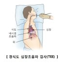 난원공 개존증(Patent Foramen Ovale) 순환기질환이란? 이미지