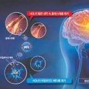 당뇨에 걸리면 치매걸릴 확률이 높아진다는 &#39;3형당뇨&#39; 이미지