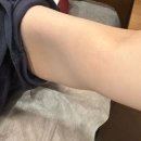 몸편안한의원 | 수원다이어트한의원 팔뚝 살처짐 고민 끝낸 노블쉐이프 내돈내산 후기