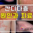 칸디다균, 칸디다증 원인 알아볼게요! 이미지