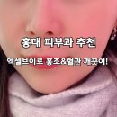 홍대전철역 KT옆 | 홍대피부과 엑셀브이로 달라진 코 옆, 전후 비교 솔직후기