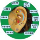 귀 건강학(이혈테라피) 네이버블로그