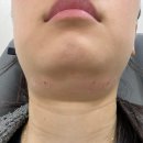 역삼제3 | 강남역 이중턱 얼굴지방분해주사 역삼제로팻 3회차 후기(부작용, 붓기)